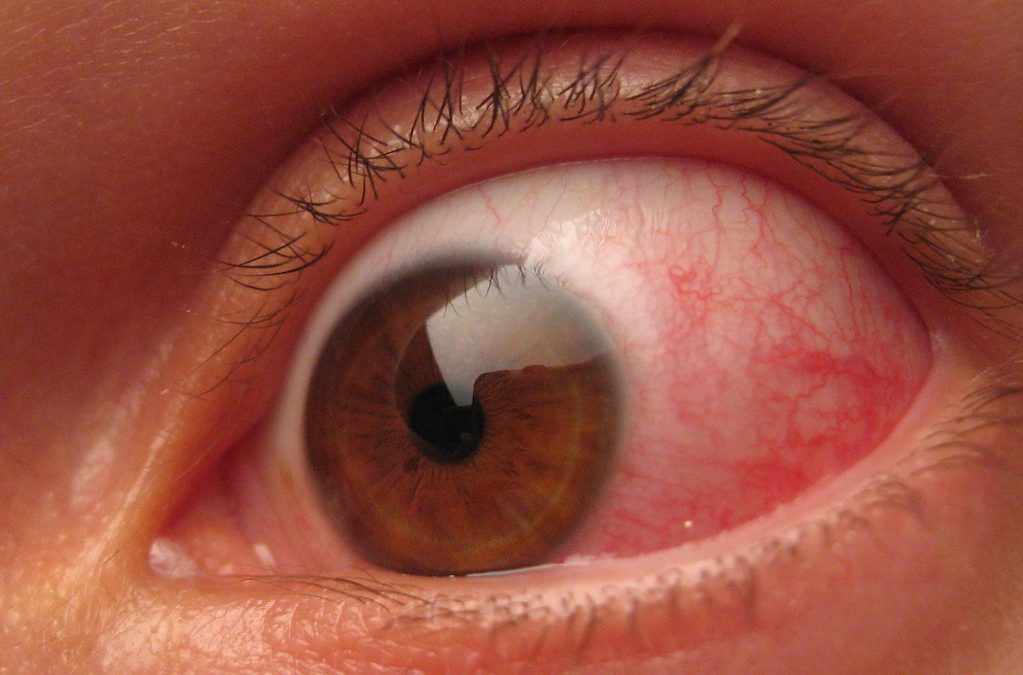Why Do I Have Red Eyes After Sleeping in Contacts?
